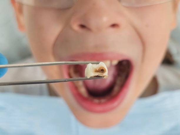 Best Same-Day Emergency Dentist in Cokato, MN